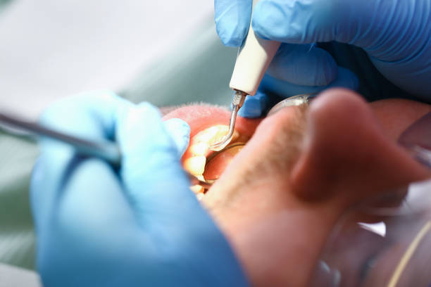 Best Urgent Care for Lost Fillings or Crowns in Tahoma, CA